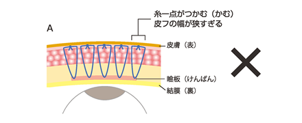 腫れにくくするための当院の工夫